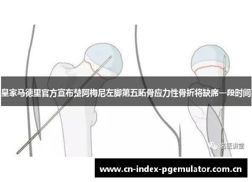 皇家马德里官方宣布楚阿梅尼左脚第五跖骨应力性骨折将缺席一段时间 皇家马德里官方宣布楚阿梅尼左脚第五跖骨应力性骨折将缺席一段时间